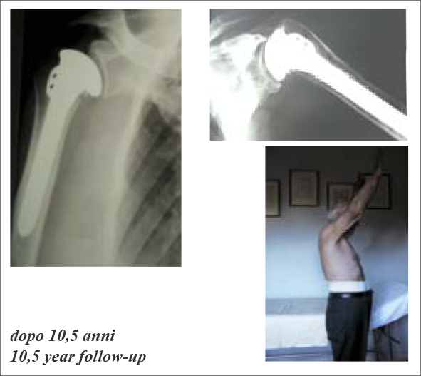 trattamento-fratture-fig11